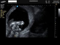 3D Ultrasound.jpg
